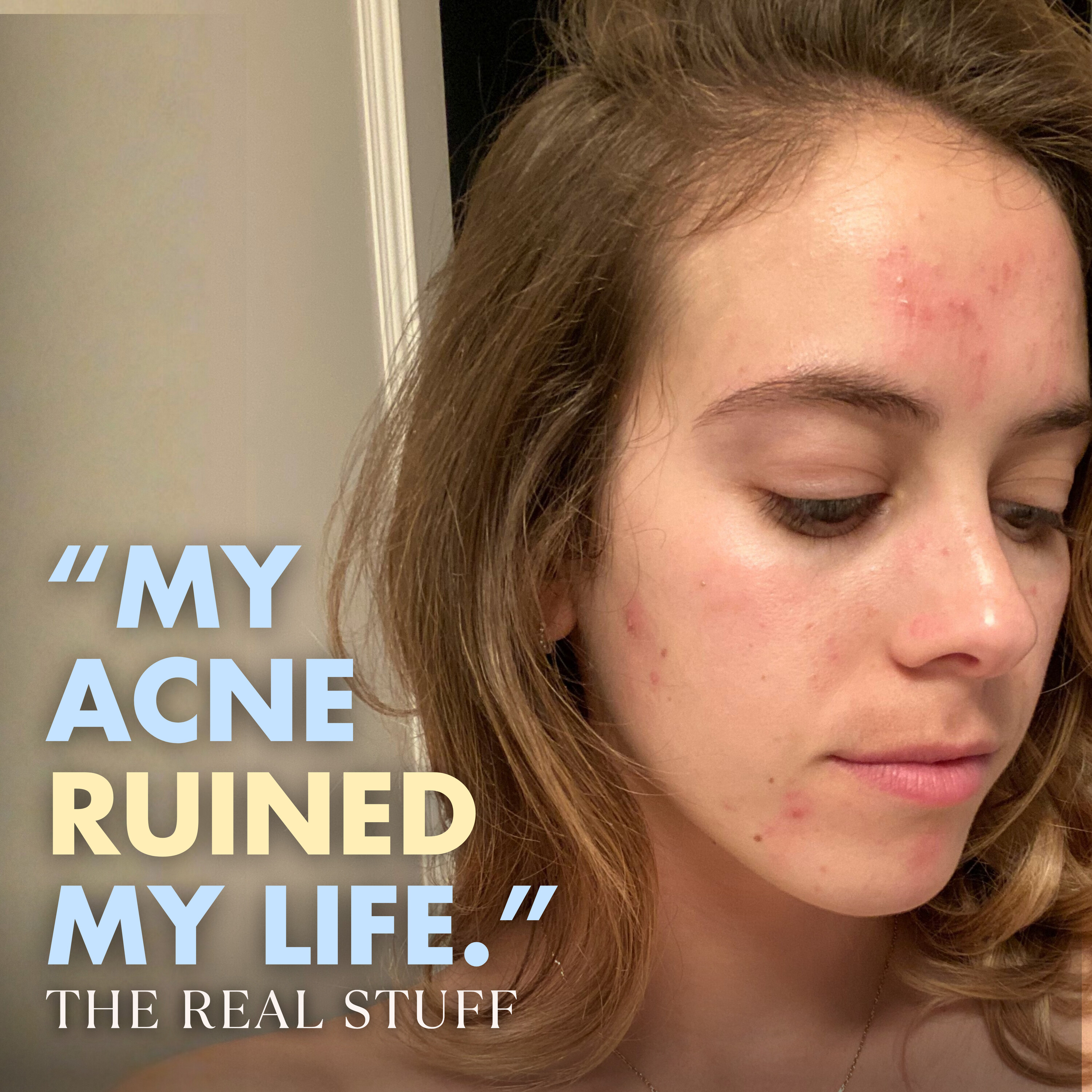 The Acne Episode (so many things I didn’t know about breakouts)